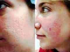 Pelle con acne prima e dopo trattamento, miglioramento visibile, cura della pelle, cosmetici, bellezza viso, skincare, trattamento acne, risultati, glow naturale.