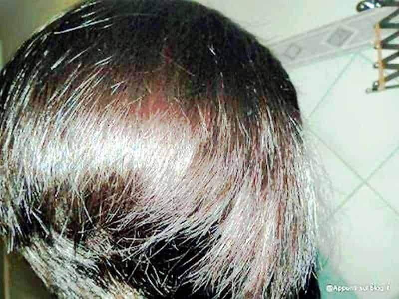 trattamenti e cure naturali per la perdita di capelli 