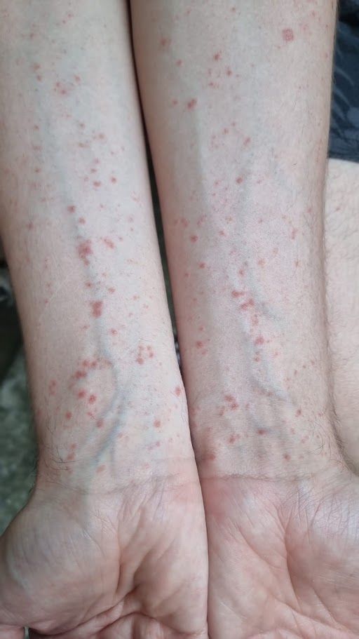 Malattie della pelle contagiose dei bimbi: sintomi e prevenzione 5 infezioni cutanee sulle braccia