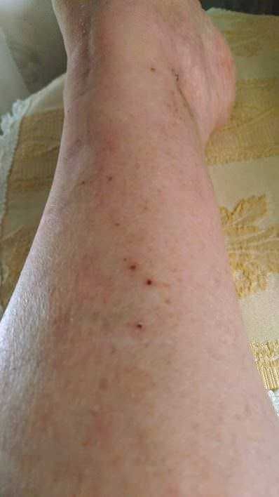 Zza schiena con segni cutanei e piccole lesioni visibili, possibile segno di condizioni cutanee o dermatologiche di interesse medico e sanitario.