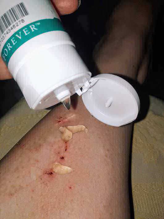 Forever living Aloe vera a scudo della pelle 5 Crema farmaceutica per il trattamento di ferite e infezioni cutanee, applicata sulla pelle lesa.