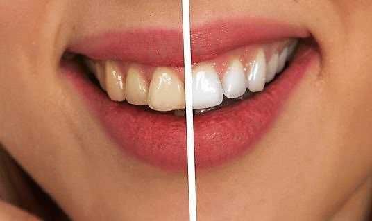Sorriso con denti sani e bianchi, prima e dopo trattamento di sbiancamento dentale, sorriso luminoso e cura dentale professionale.