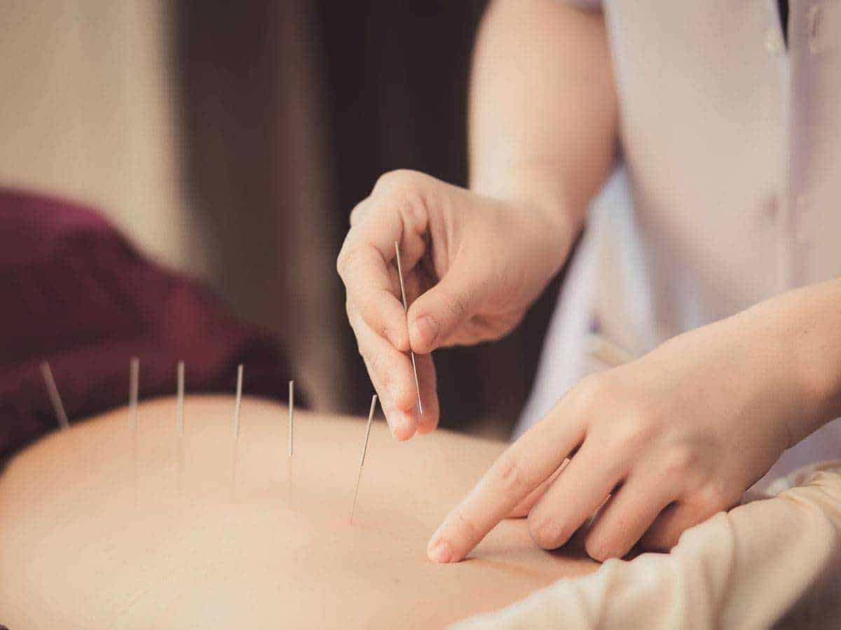 Agopuntura sul addome in trattamento terapeutico, immagini di medicina alternativa e benessere naturale. Terapia con aghi per alleviare dolore e stress, approccio olistico alla salute.
