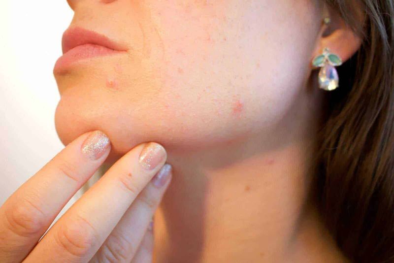 Effetto placebo 10 miti nel corso della Storia 4 Pelle con acne e punti neri sul viso di una donna, primo piano, cura della pelle, problemi cutanei.
