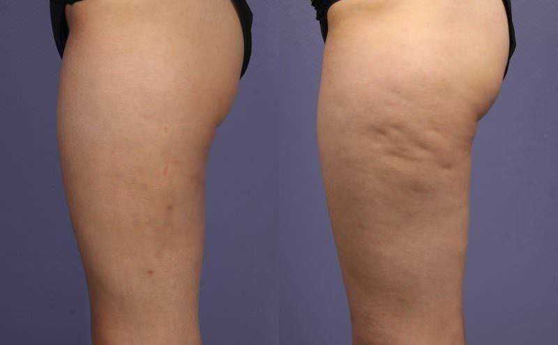Pantaloni corti neri che mettono in evidenza le gambe di una persona, evidenziando le differenze di aspetto tra due immagini per confronto.