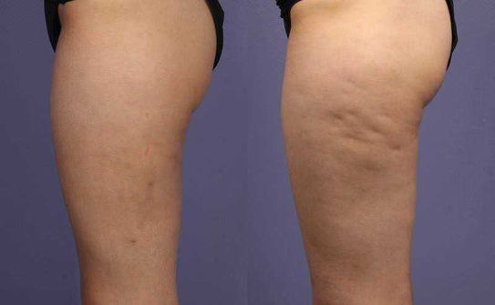 Bioniva anticellulite massage oil con 7 oli essenziali efficaci 2 Pantaloni corti neri che mettono in evidenza le gambe di una persona, evidenziando le differenze di aspetto tra due immagini per confronto.