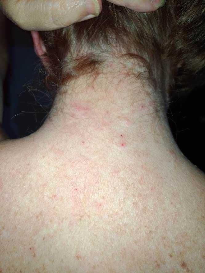 Puntura di insetto sul collo, irritazione cutanea e puntini rossi, possibile reazione allergica o puntura di zanzara, risposta infiammatoria localizzata, consigli medici raccomandati per trattamento e alleviamento sintomi.