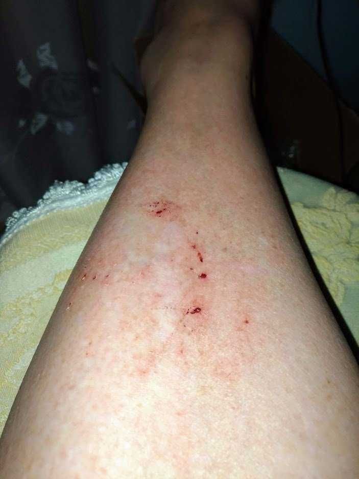 Ferita sulla gamba con piccoli sanguinamenti e arrossamenti, probabilmente da trauma o intervento chirurgico.