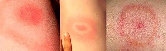 Come riconoscere le punture di insetti 3 Morso di zecca con zecca ancora attaccata alla pelle