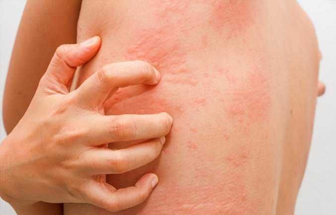 Rossore cutaneo e pielo irritata a causa di dermatite o allergia, con prurito e infiammazione sulla schiena. Problema comune che richiede cure dermatologiche e trattamenti specifici per alleviare i sintomi.