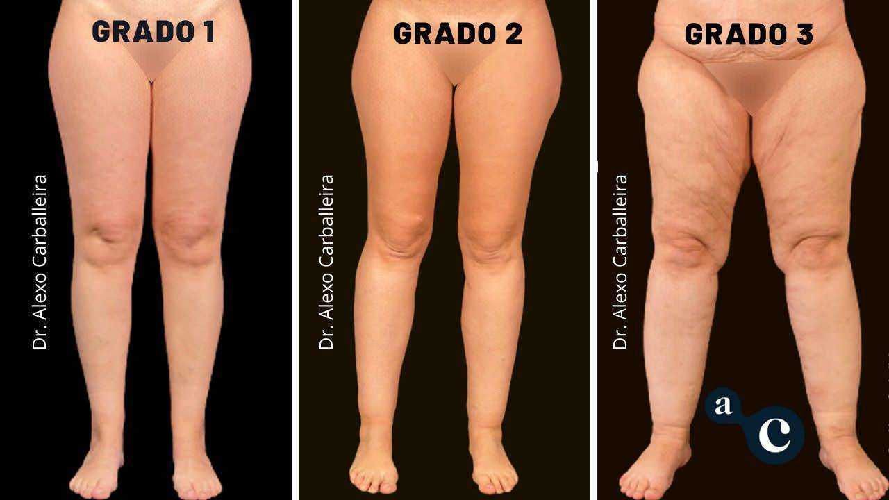 Lipedema sindrome gambe gonfie e trattamenti (2026). Grado 1, 2 e 3 della cellulite sulle gambe, confronto visivo delle diverse gravità con variazioni di compattezza e invecchiamento della pelle, cura estetica e trattamenti dermatologici.