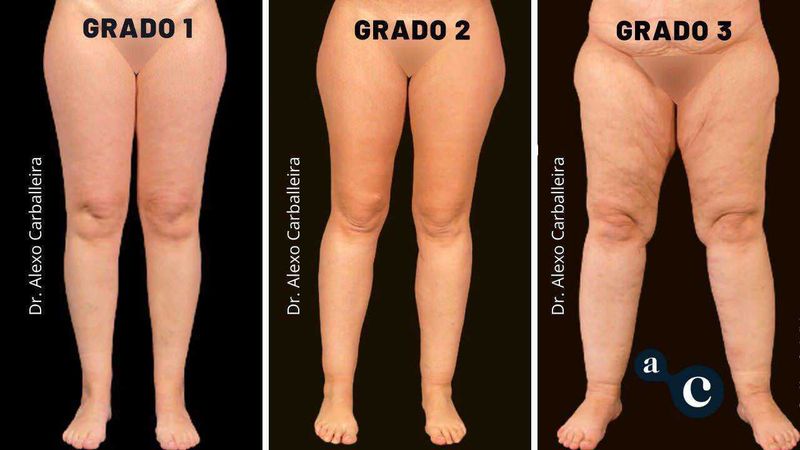 Lipedema sindrome gambe gonfie e trattamenti (2026) 5 Lipedema sindrome gambe gonfie e trattamenti (2026). Grado 1, 2 e 3 della cellulite sulle gambe, confronto visivo delle diverse gravità con variazioni di compattezza e invecchiamento della pelle, cura estetica e trattamenti dermatologici.