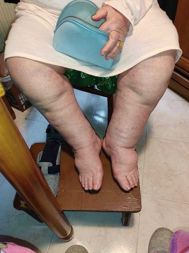 Lipedema sindrome gambe gonfie e trattamenti (2026) 3 Lipedema sindrome gambe gonfie e trattamenti (2026)