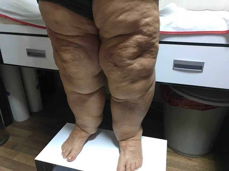 Lipedema sindrome gambe gonfie e trattamenti (2026) 2 Lipedema sindrome gambe gonfie e trattamenti (2026). Patologie legate all’accumulo anomalo di tessuto adiposo