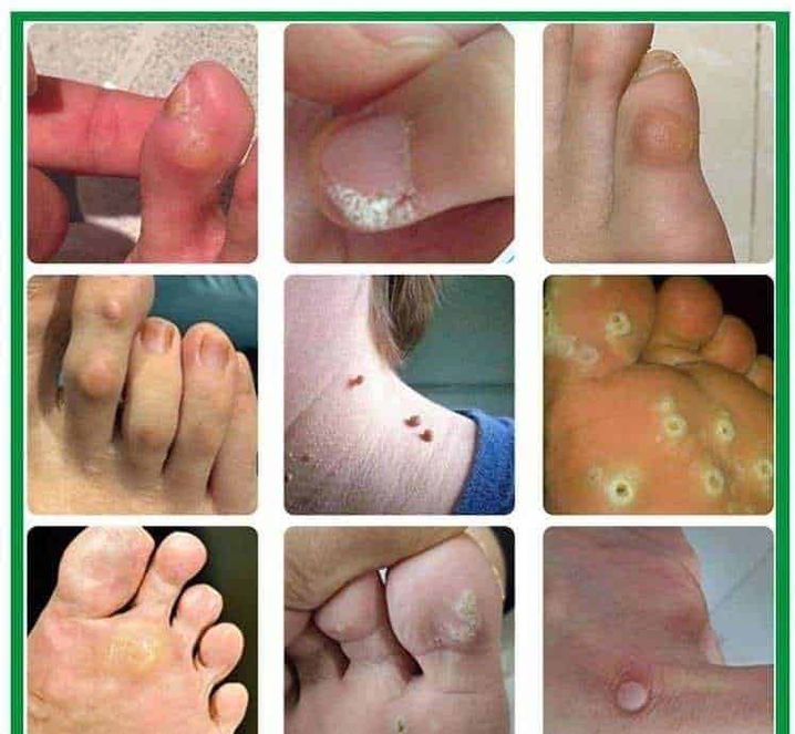 Rimedio naturale per eliminare i calli dei piedi senza dolore. 2 Calli dei piedi: Scarpa da ginnastica posizionata sull'erba con una persona che si lega la scarpa, ambientazione all'aperto con luce naturale, stile casual, perfetta per articoli su sport, fitness e stile di vita attivo.