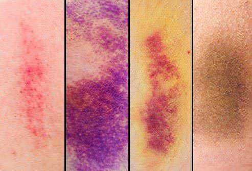 Come eliminare i lividi, 13 rimedi naturali 2 Come eliminare i lividi, 13 rimedi naturali (2026). Palette di colori che richiama le fasi di guarigione di un livido, dal rosso al giallo-verde