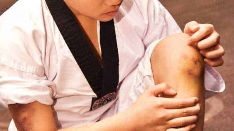 Comparsa di lividi inspiegabili, 7 cause tra cui le malattie del sangue 2 Malattie del sangue: Comparsa di lividi inspiegabili, 7 cause di salute