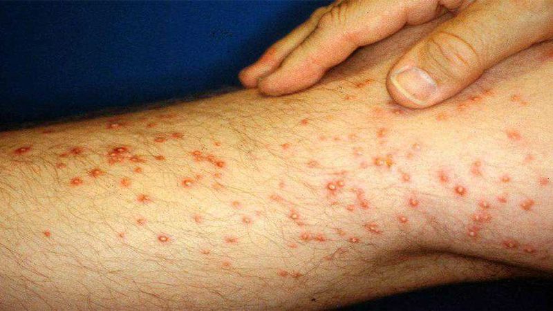 Come riconoscere le punture di insetti 11 Puntura di formica rossa