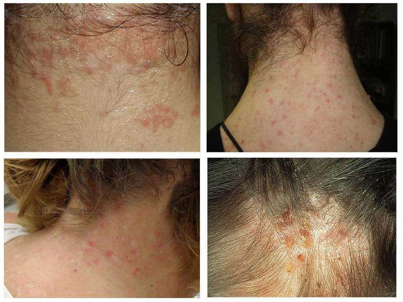 Come riconoscere le punture di insetti per curarsi bene 10 Punture di pidocchi e lendini tra i capelli