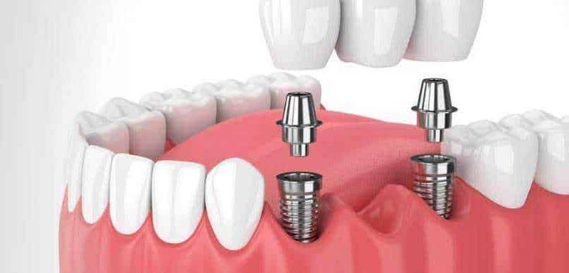 Vale la pena recarsi in Albania per gli impianti dentali? 2 Impianti dentali in albania: Vale la pena recarsi in Albania per gli impianti dentali?