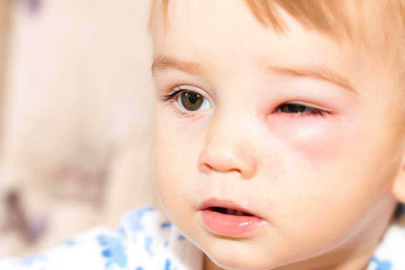 Come riconoscere le punture di insetti 9 Puntura di vespa sotto l'occhio di un bambino.