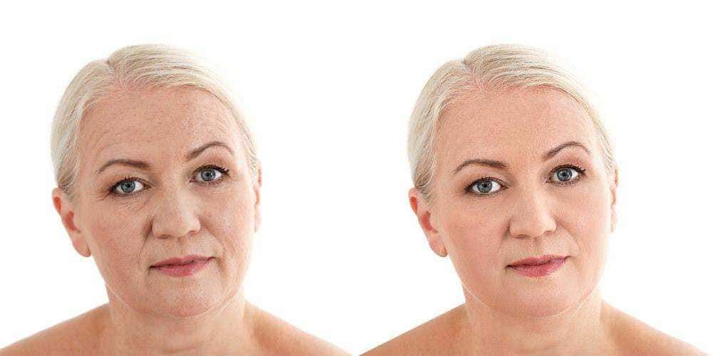 Ringiovanimento del viso, before and after, trattamento anti-età, miglioramento dell'aspetto della pelle, risultati visibili, skincare, riduzione delle rughe, foto di trasformazione, cura della pelle, bellezza e giovinezza.