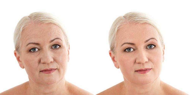 13 Trattamenti estetici antietà donna over 45 6 Ringiovanimento del viso, before and after, trattamento anti-età, miglioramento dell'aspetto della pelle, risultati visibili, skincare, riduzione delle rughe, foto di trasformazione, cura della pelle, bellezza e giovinezza.