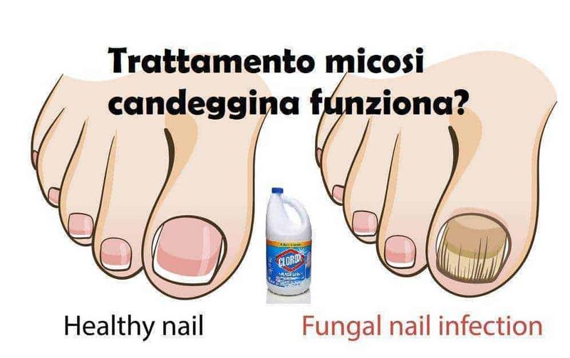 Rimedi casalinghi per onicomicosi: il trattamento micosi con candeggina funziona? 2 Trattamento micosi candeggina funziona?