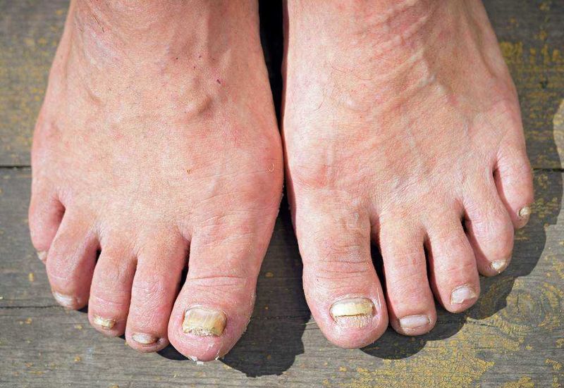 Rimedi casalinghi per onicomicosi: il trattamento micosi con candeggina funziona? 4 Trattamento micosi candeggina funziona?