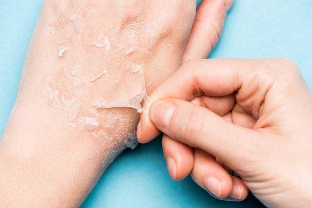 Disidratazione durante la dieta chetogenica