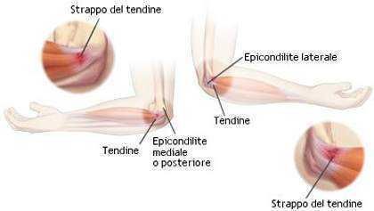 Tendinite, come curarla con prodotti naturali 6 Dolore al tendine e infiammazione del gomito, epicondilite laterale e tendinite, trattamento e sintomi della tendinopatia al braccio.