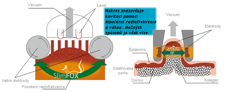 tecnica di liposuzione