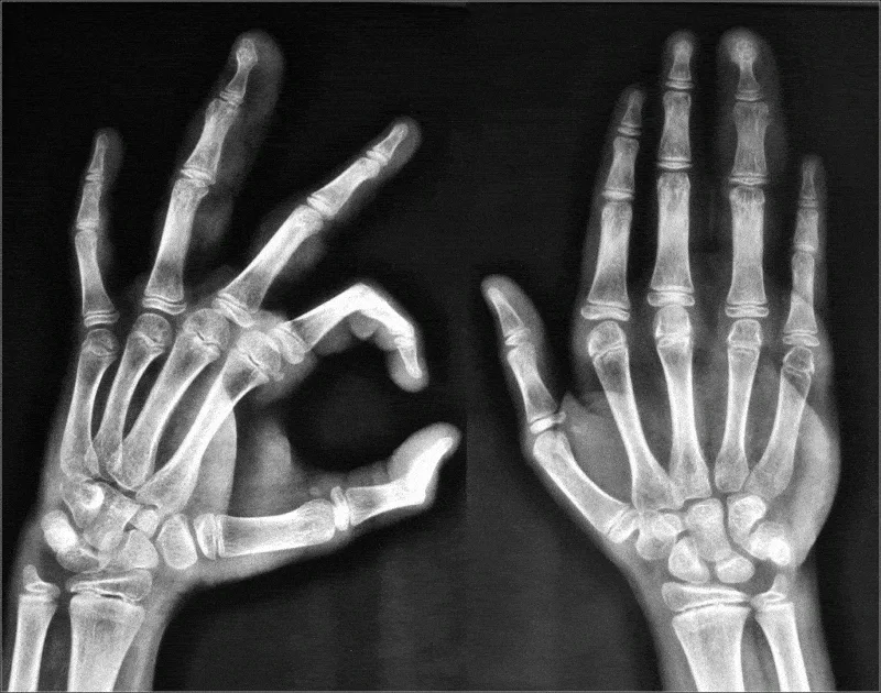 Scrocchiare le dita fa male alle articolazioni? 2 Scrocchiare le dita o il collo: cosa succede alle articolazioni