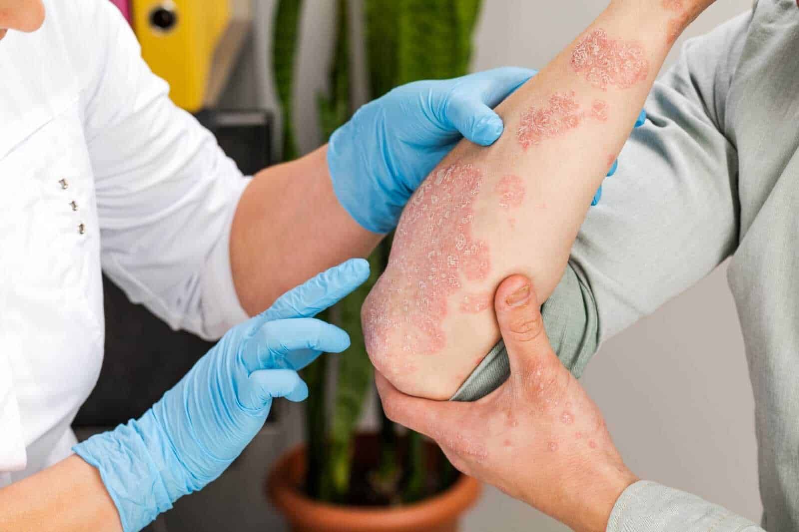 Psoriasi con placche e arrossamento della pelle