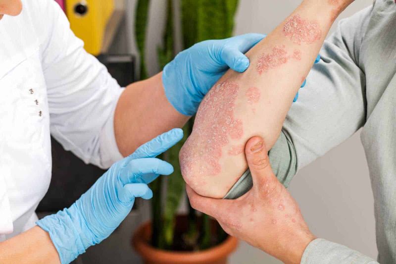 10 malattie autoimmuni gravi: quali sono e quali esami fare 6 Psoriasi con placche e arrossamento della pelle