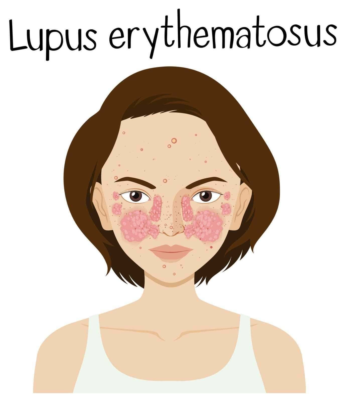 Lupus eritematoso sistemico con manifestazioni cutanee