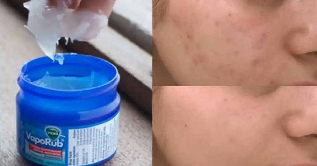 Vicks VapoRub e acne