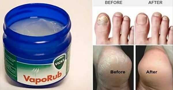 Vicks VapoRub e 20 usi alternativi per il benessere del corpo 7 Vicks VapoRub per talloni screpolati