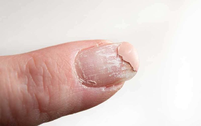 Segnali del corpo che qualcosa non va, 9 carenze nutrizionali 3 Cutteria con residui di smalto e pelle secca sotto l’unghia del pollice, evidenziando problemi di cura delle unghie e pelle, concetto di bellezza e igiene delle mani.