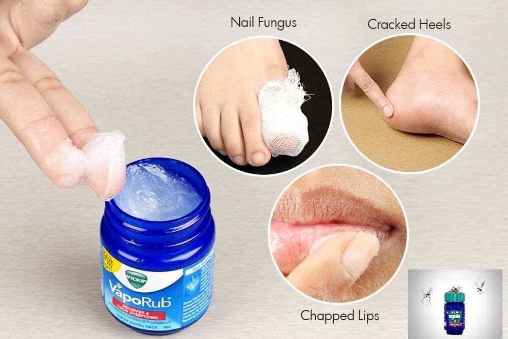 usi alternativi del vicks vaporub ILLUSTRATI Vicks VapoRub e punture di insetti