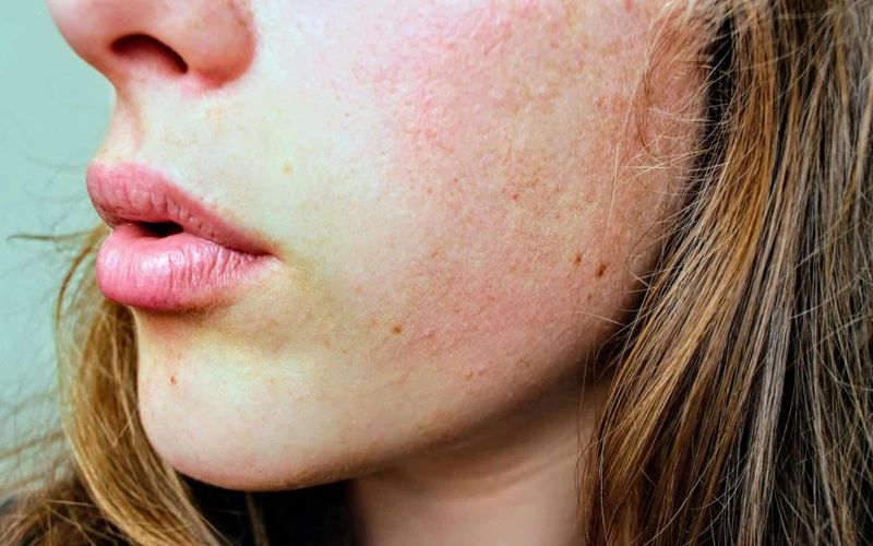 Autunno pelle secca: cause e rimedi efficaci 3 Pelle acneica e punti neri sul viso di una ragazza con capelli castani, evidenziando problemi di pelle e cura del viso.