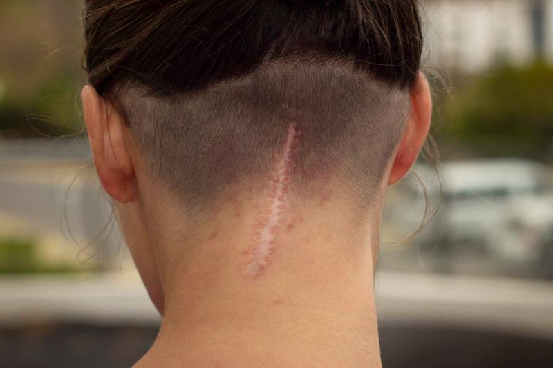 Perché le Cicatrici non si abbronzano e non ricrescono i peli 4 Perché le Cicatrici non si abbronzano e non ricrescono i peli. Immagine di una nuca con una cicatrice evidente a causa di un intervento chirurgico, visibile sulla parte posteriore del collo.