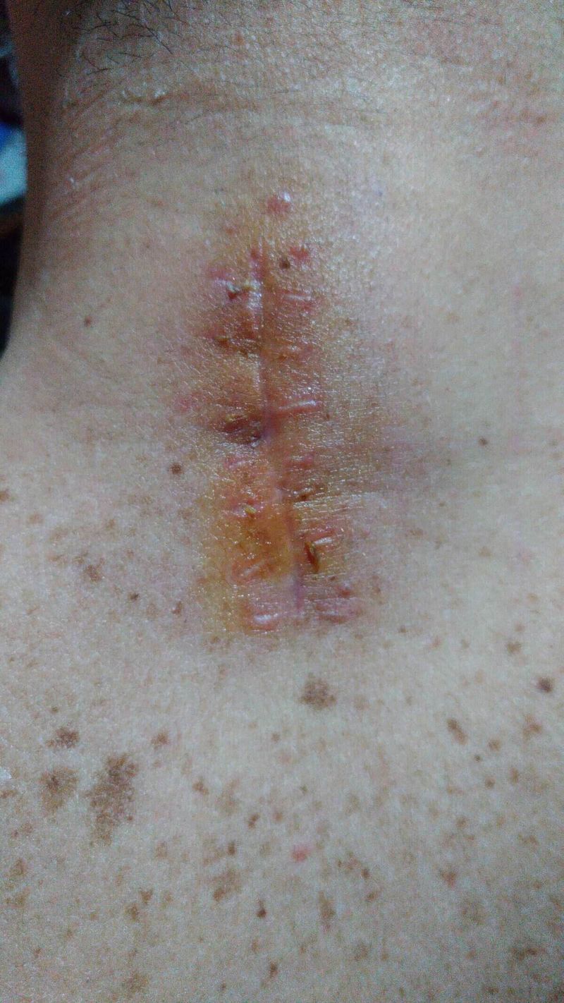 Perché le Cicatrici non si abbronzano e non ricrescono i peli 2 Perché le Cicatrici non si abbronzano e non ricrescono i peli. Immagine di una cicatrice infiammata e cicatrizata sulla pelle, con segni di infiammazione e cicatrici recenti e vecchie.