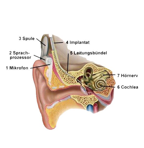 Cochlear-Implantat 