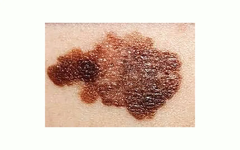 علائم ملانوما چیست؟